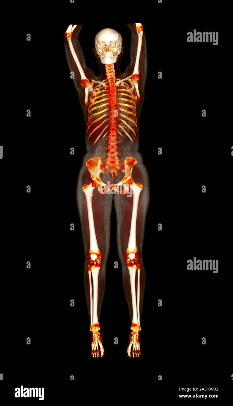 Female body, CT scan. Threedimensional computed tomography (CT) scan