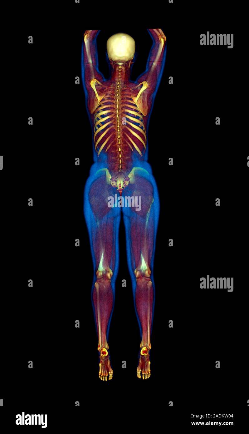 Female body, CT scan. Threedimensional computed tomography (CT) scan