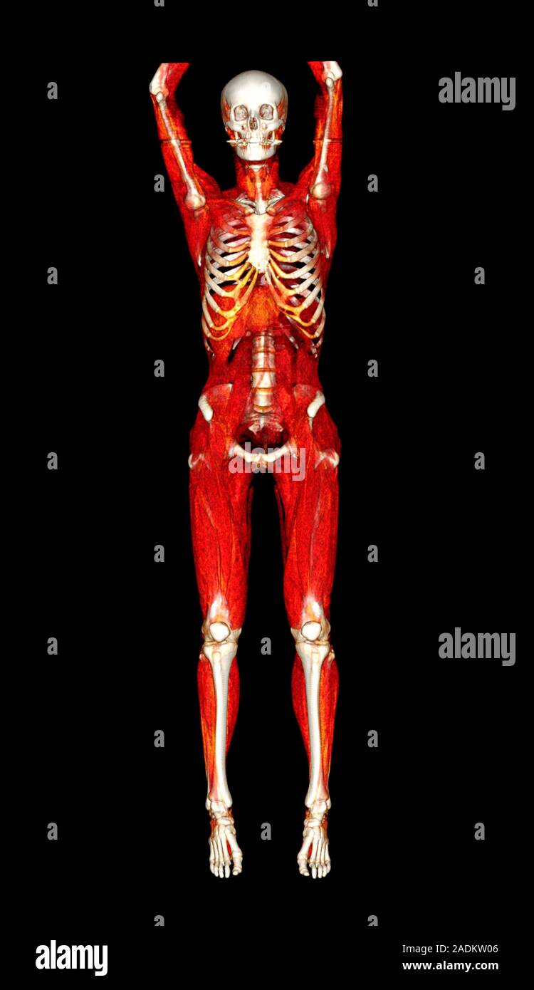 Female body, CT scan. Threedimensional computed tomography (CT) scan