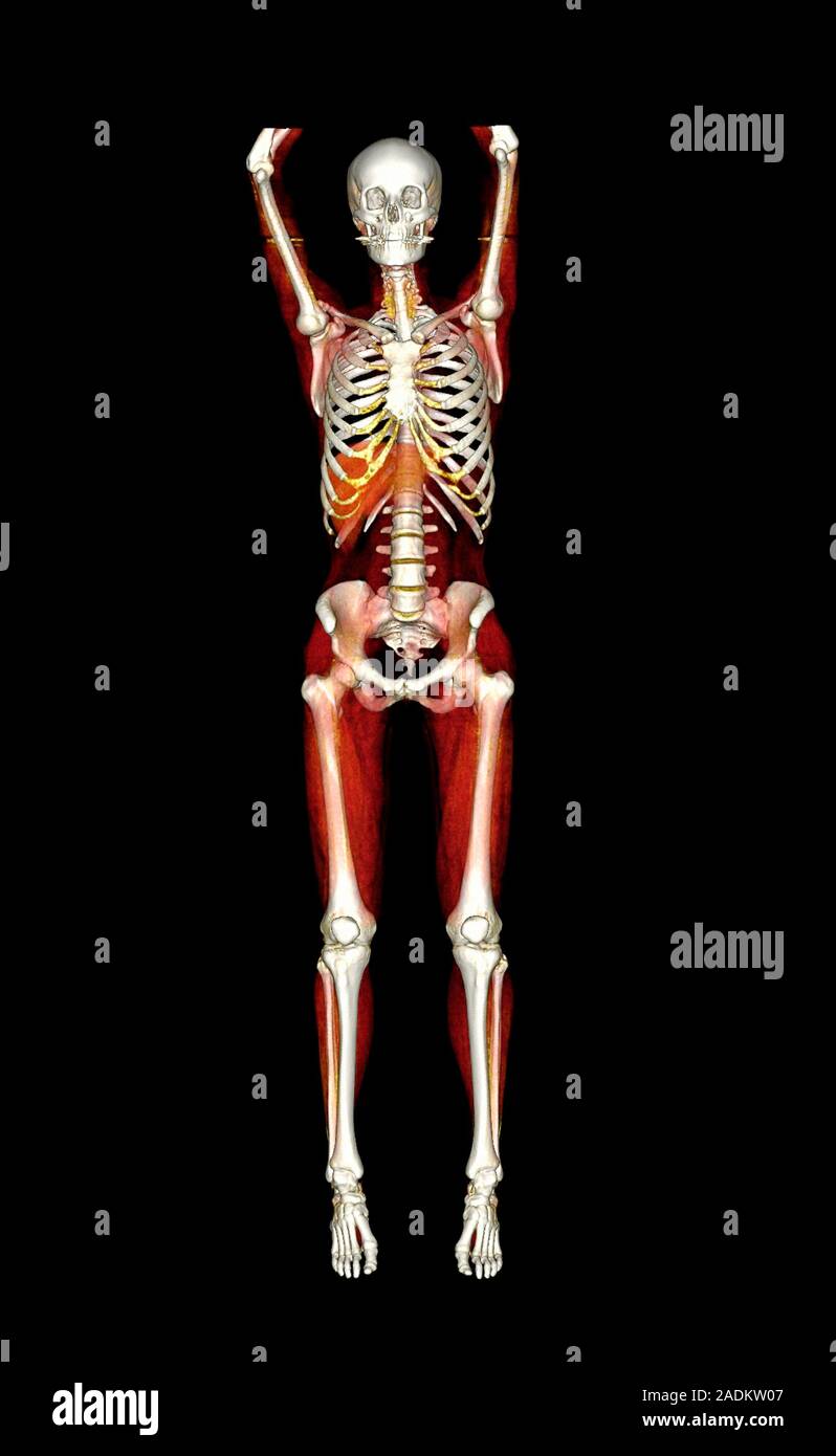 Female body, CT scan. Threedimensional computed tomography (CT) scan