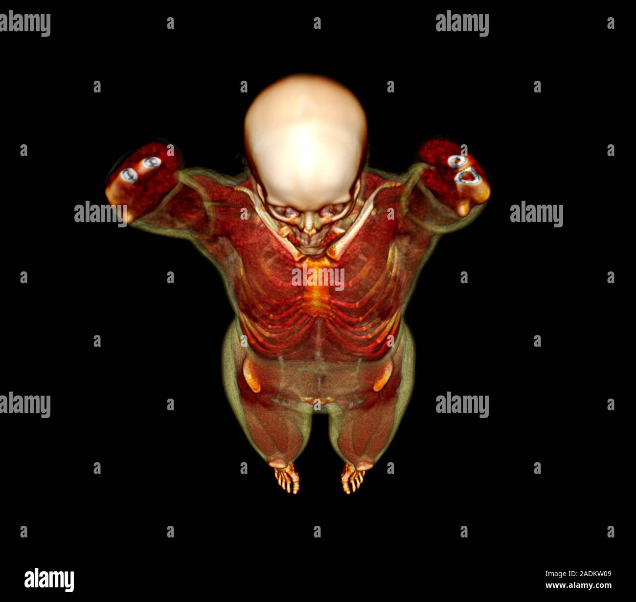 Female body, CT scan. Threedimensional computed tomography (CT) scan