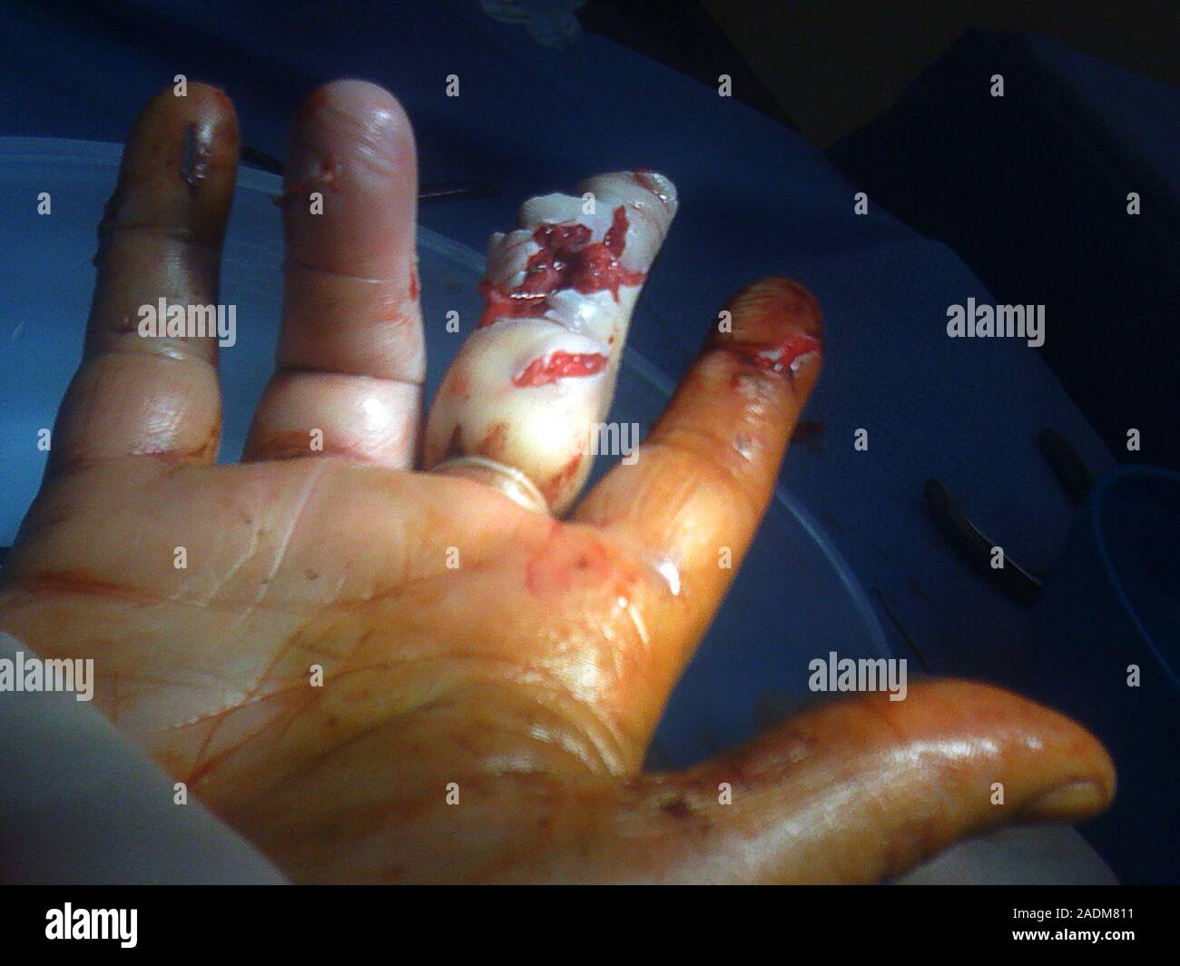 Accidental circular saw hand injury Stock Photo