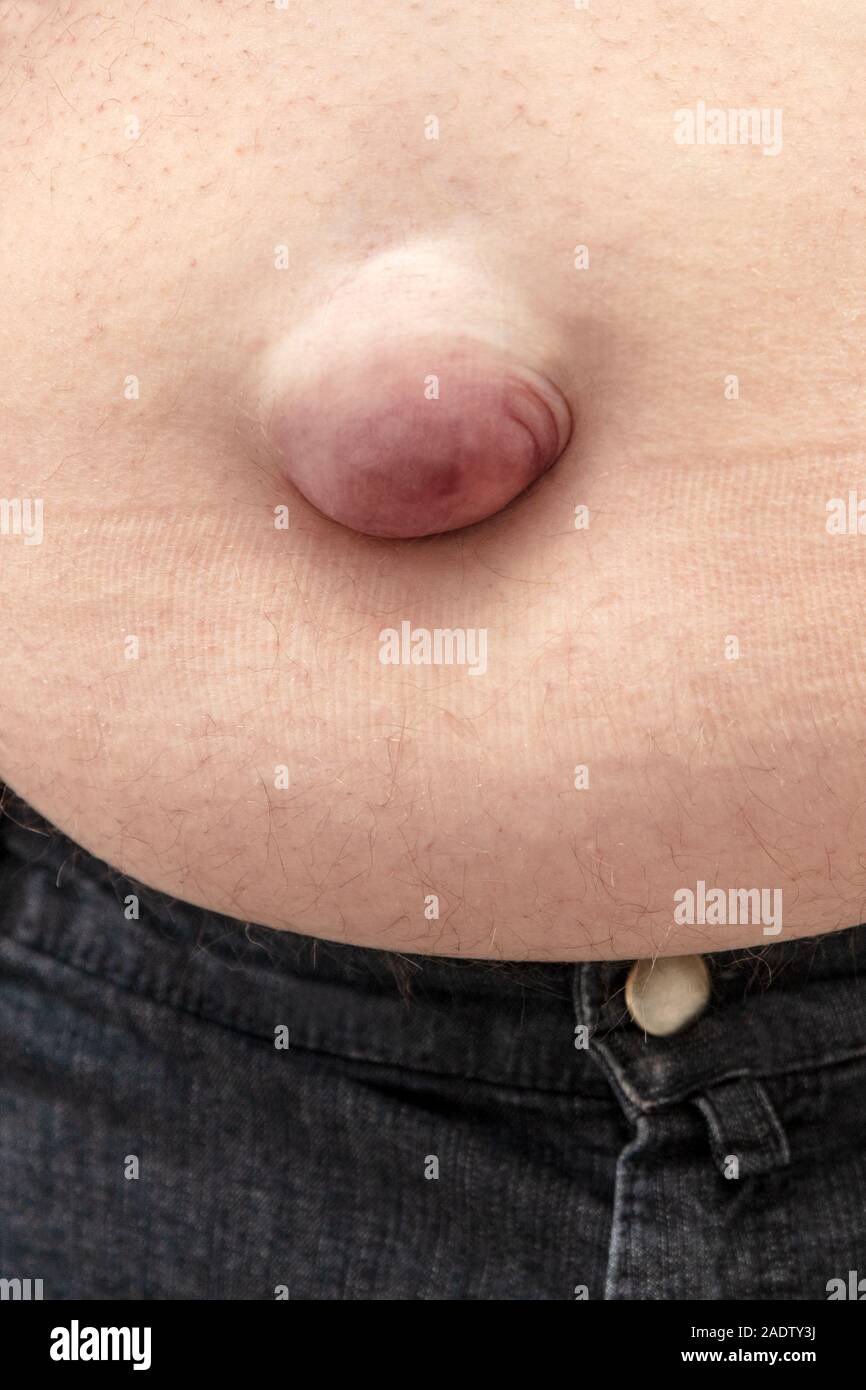 Closeup, adult man with umbilical hernia, symptoms and disease of hernia umbilicalis on the bellybutton Stock Photo