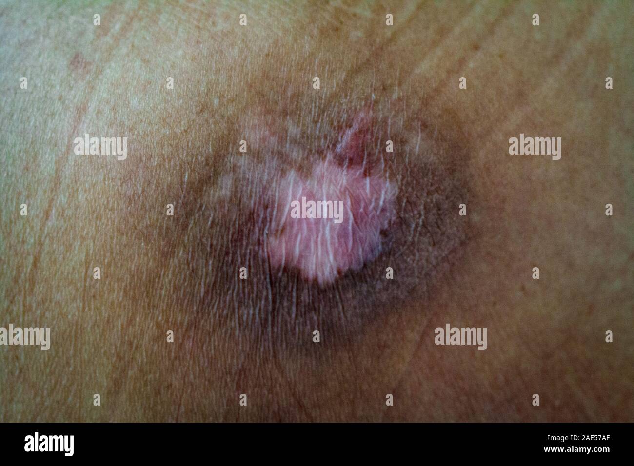 terrible bedsores with terrible wounds pressure sore on the skin of a sick lying man without the movement of an old man Stock Photo