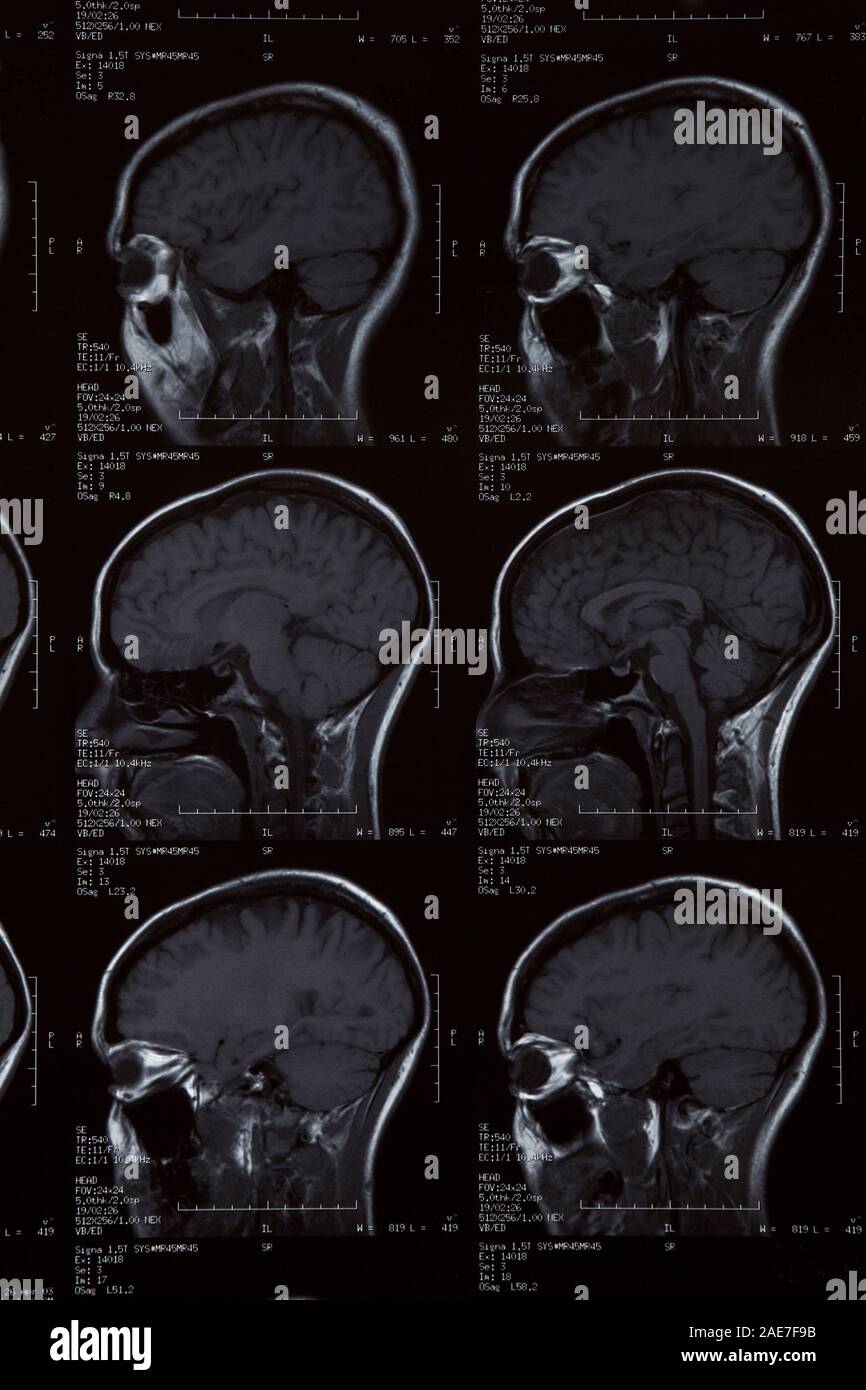 MRI Scan of female human brain Stock Photo