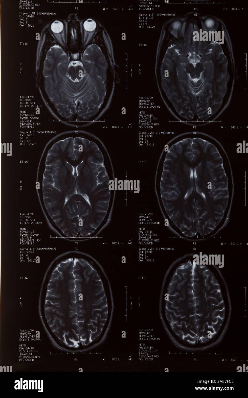 MRI Scan close up of female brain Stock Photo