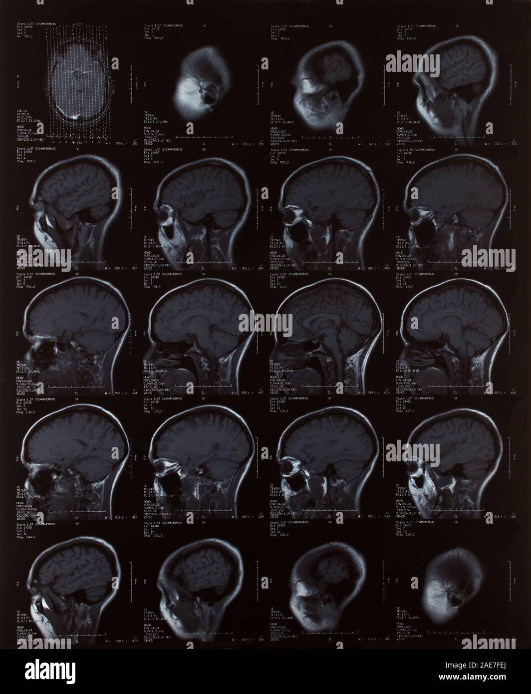 Magnetic resonance image of the female brain Stock Photo