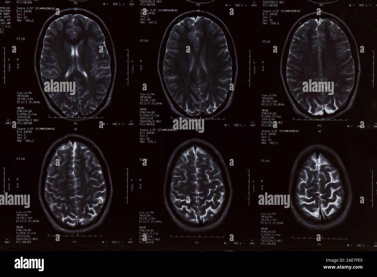 MRI Scan close up of the female brain Stock Photo