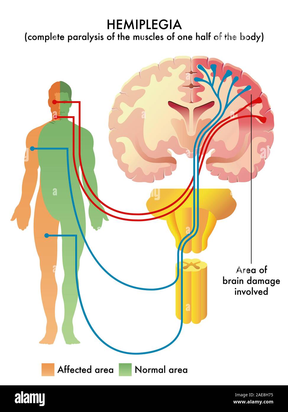 Detailed anatomical illustration of medical condition called Hemiplegia. Stock Photo