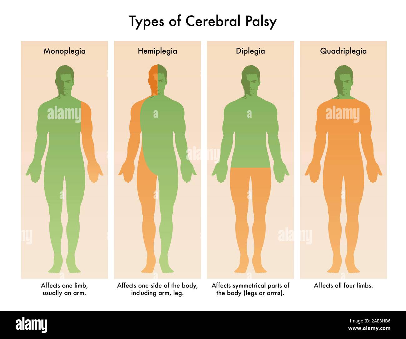 Forms of Cerebral Palsy illustrated in medical diagram. Stock Photo