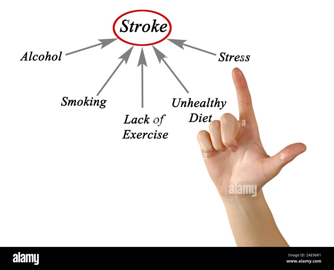 Causes of stroke hi-res stock photography and images - Alamy