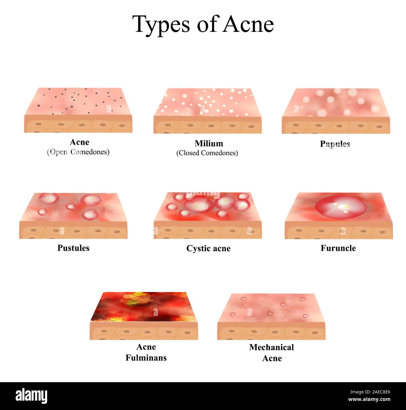 Acne Diagram
