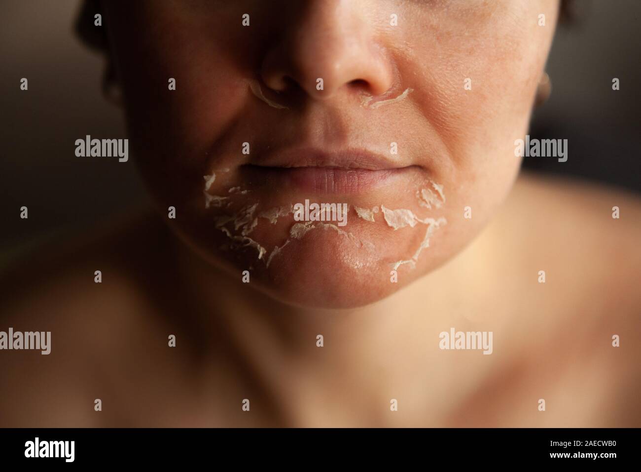 Woman's face after chemical peeling. Peeling skin on the face