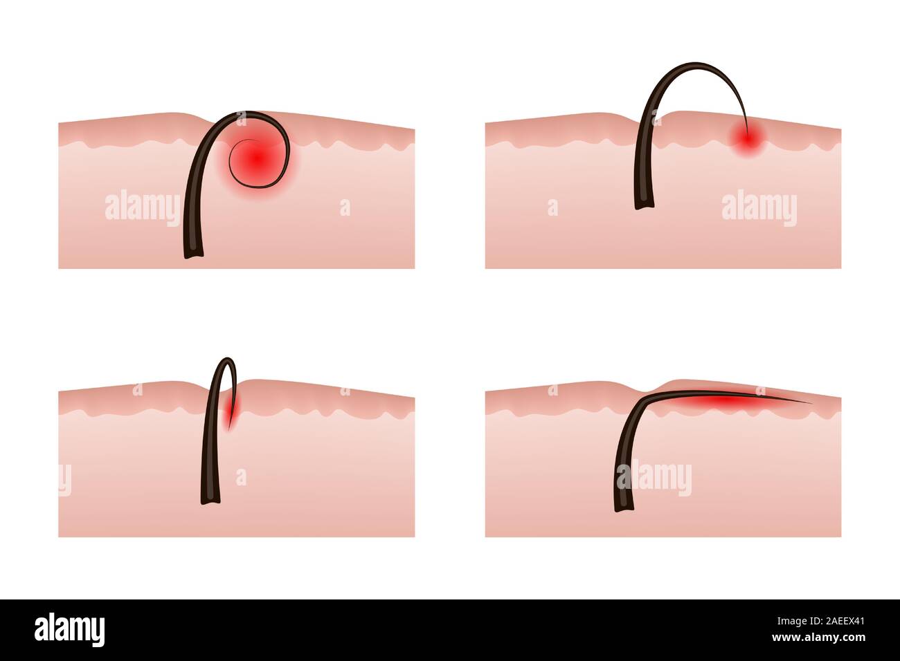 Ingrown hairs after depilation. Vector illustration. Inflammation of the skin and epidermis. Stock Vector