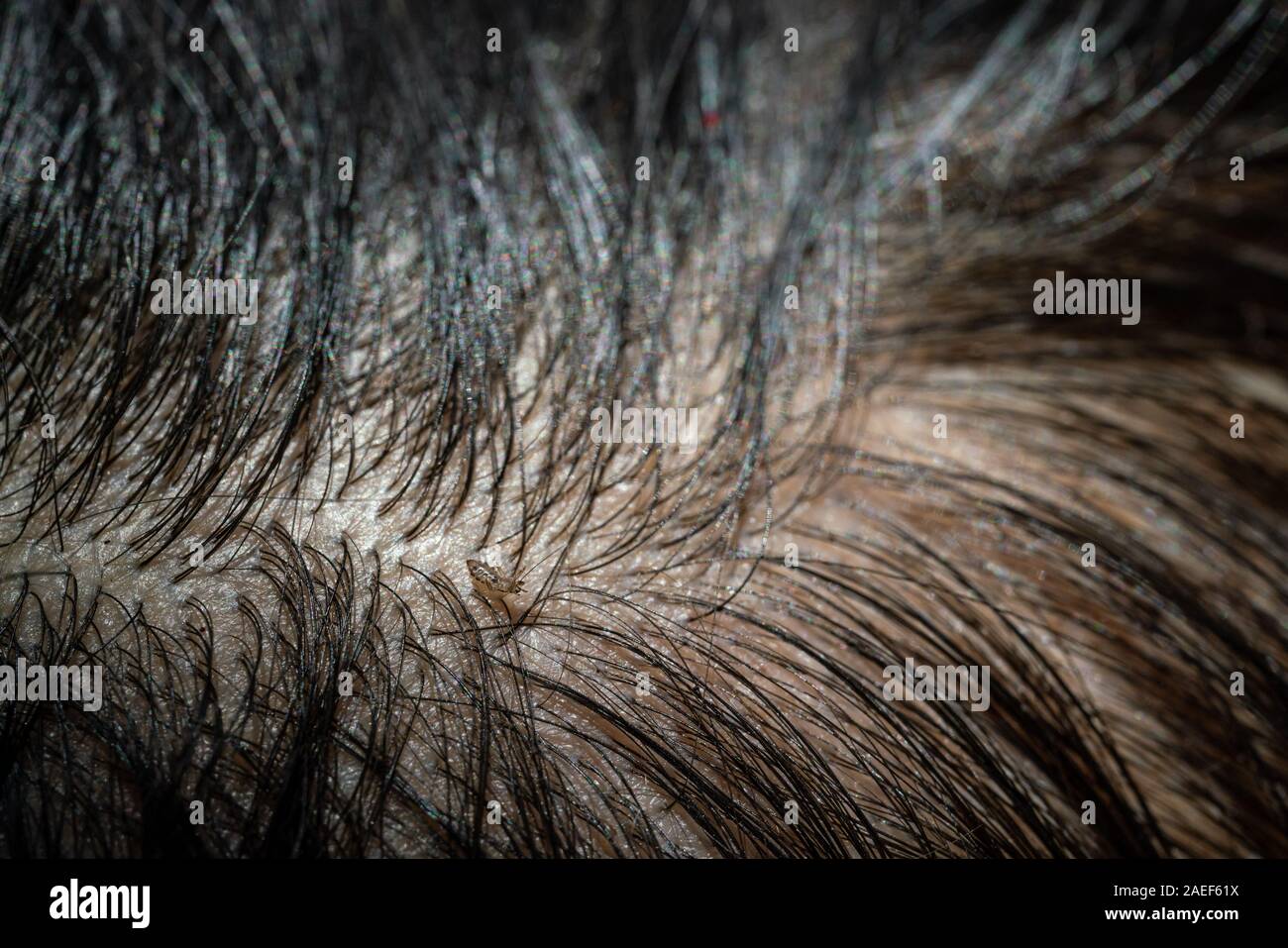 Head Lice Egg Hair Stock Photos Head Lice Egg Hair Stock Images