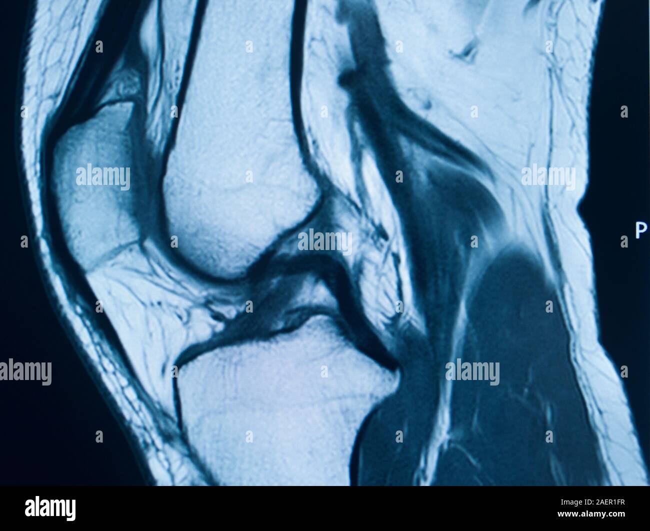 Knee sports injury mri mcl grade 2 tear resonance imaging
