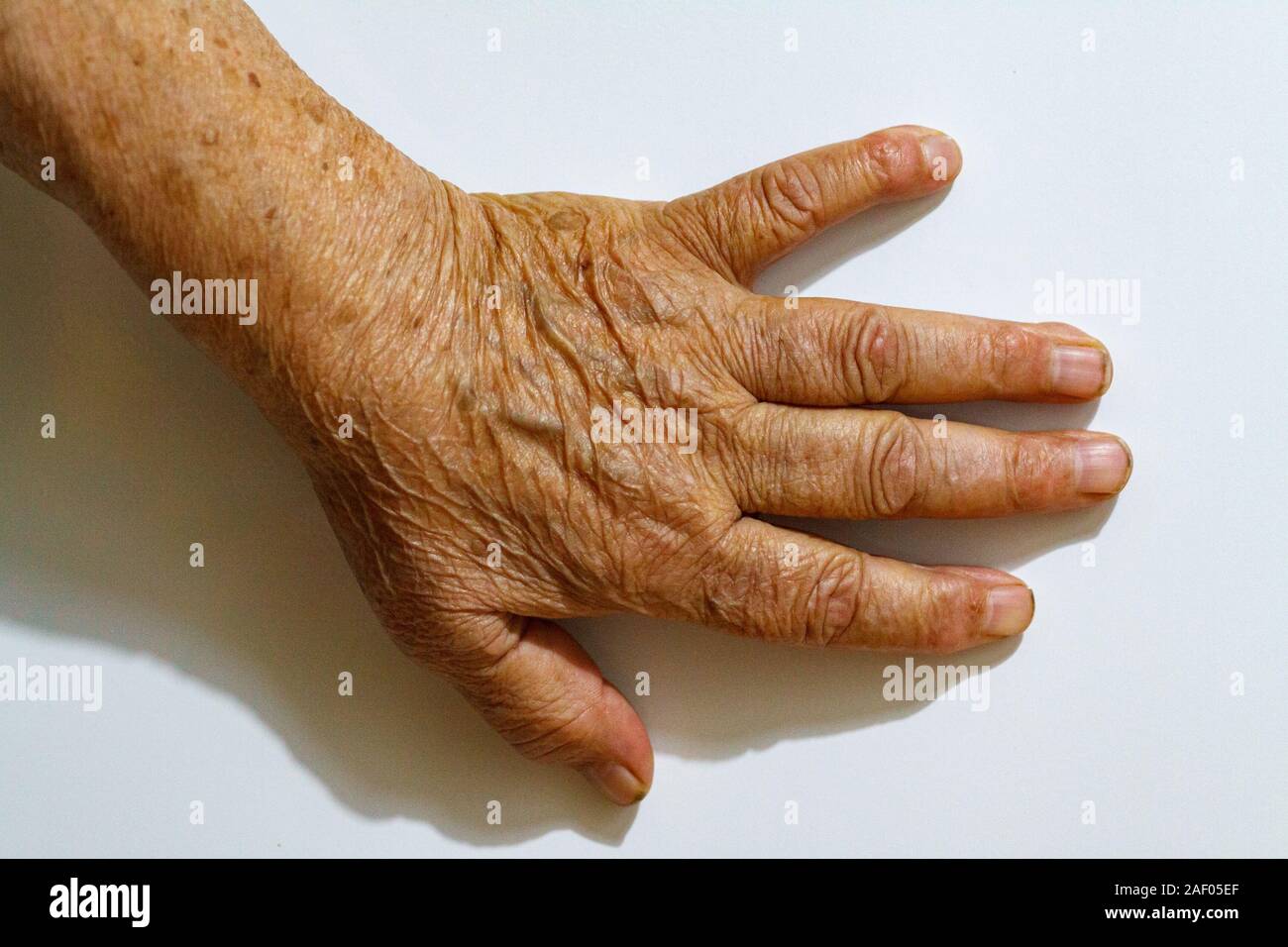 The Process Of Aging Of Human Skin Wrinkled Hands Of A Very Old Man Who Lived 90 100 Years With Dry Skin Covered With Wrinkles And Spots Stock Photo Alamy