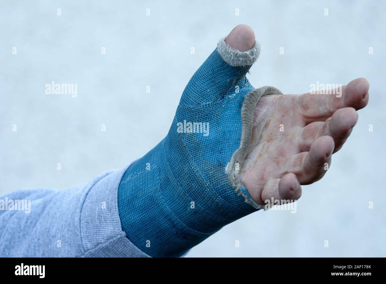 broken arm. Arm in cast Stock Photo Alamy