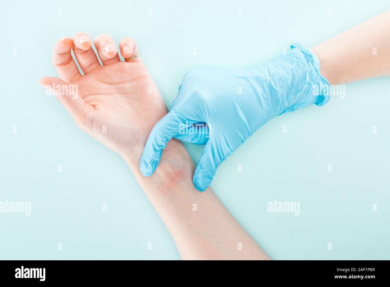 top view of doctor in latex glove showing allergic reaction on hand of