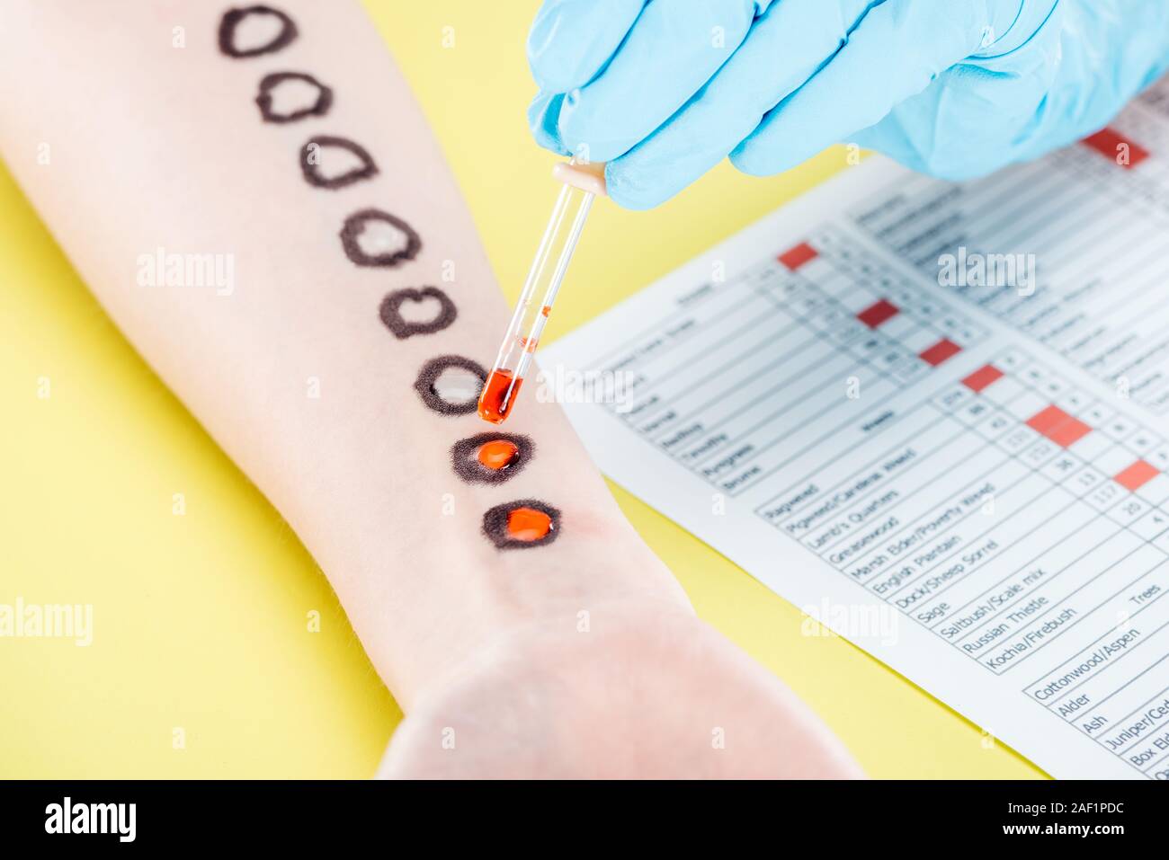 cropped view of doctor examining allergic reaction near allergy test