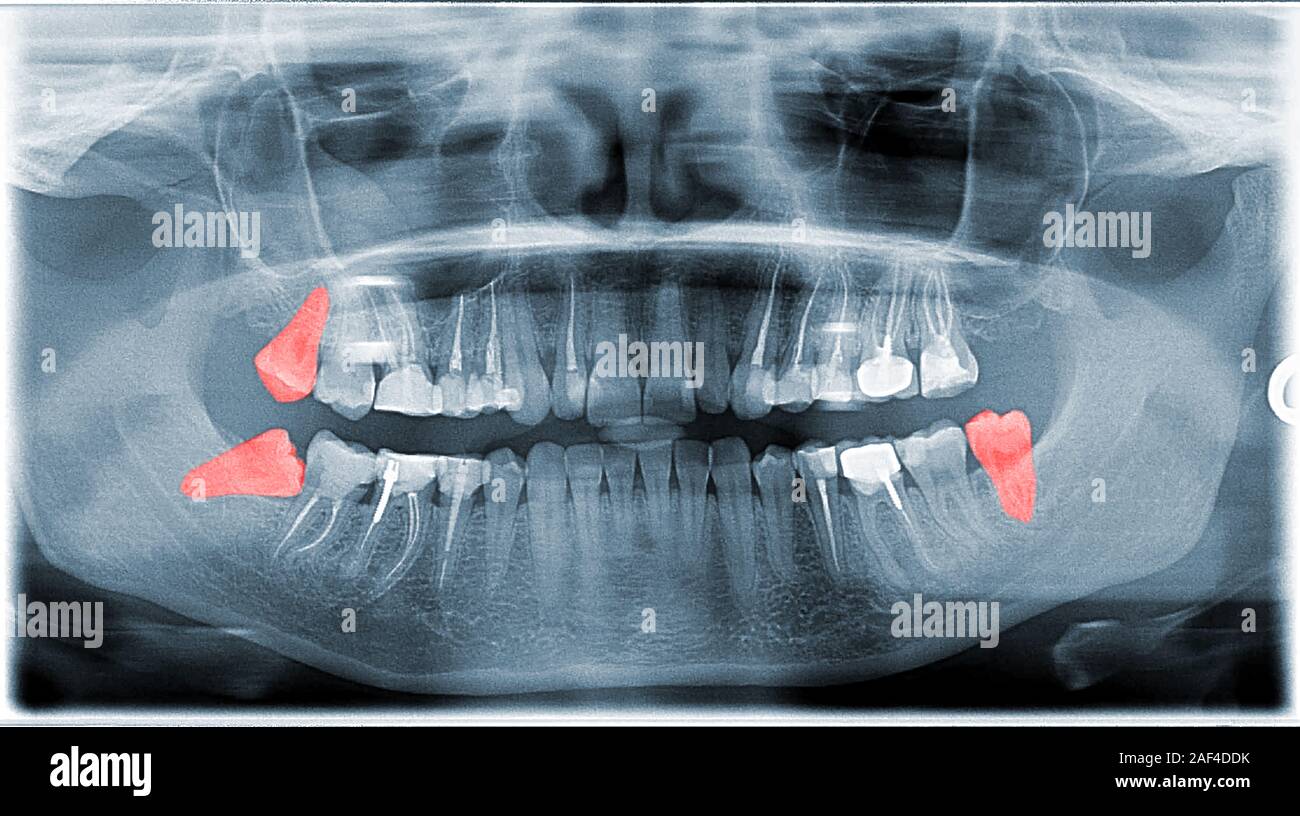 Full Frame View Of Dental Jaw Xray With Wishdom Teeth Stock Photo Alamy