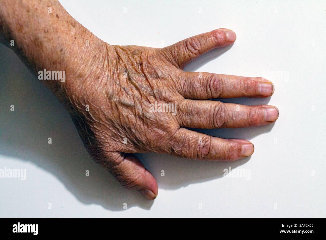 Age Spots Hands High Resolution Stock Photography And Images Alamy Age Spots Hands High Resolution Stock Photography And Images Alamy