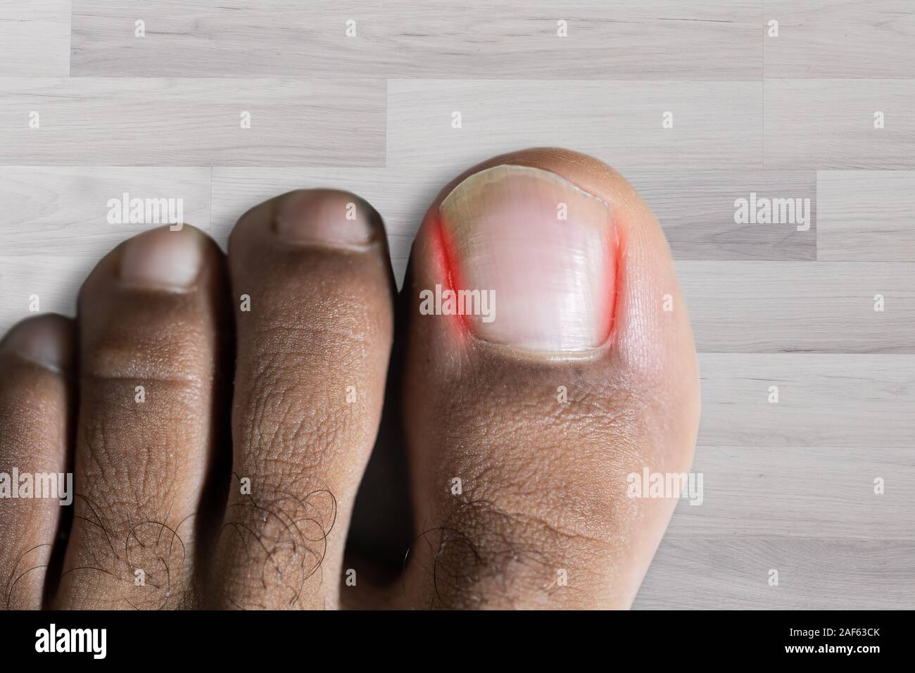 High Angle View Of Sore Toe Nail On Floor Stock Photo