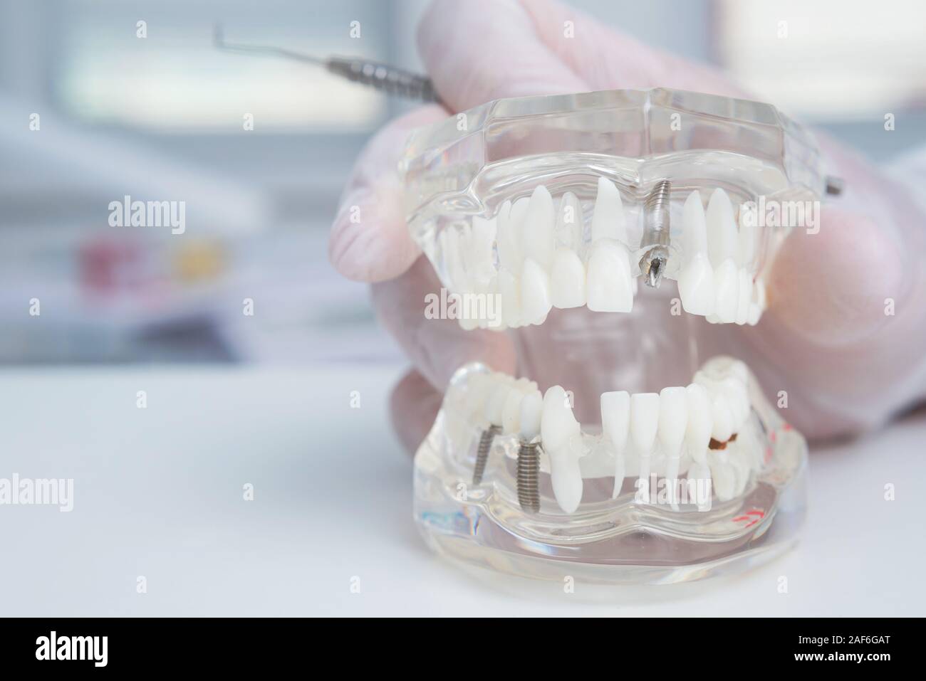 orthodontist holds a model of teeth with implants Stock Photo - Alamy