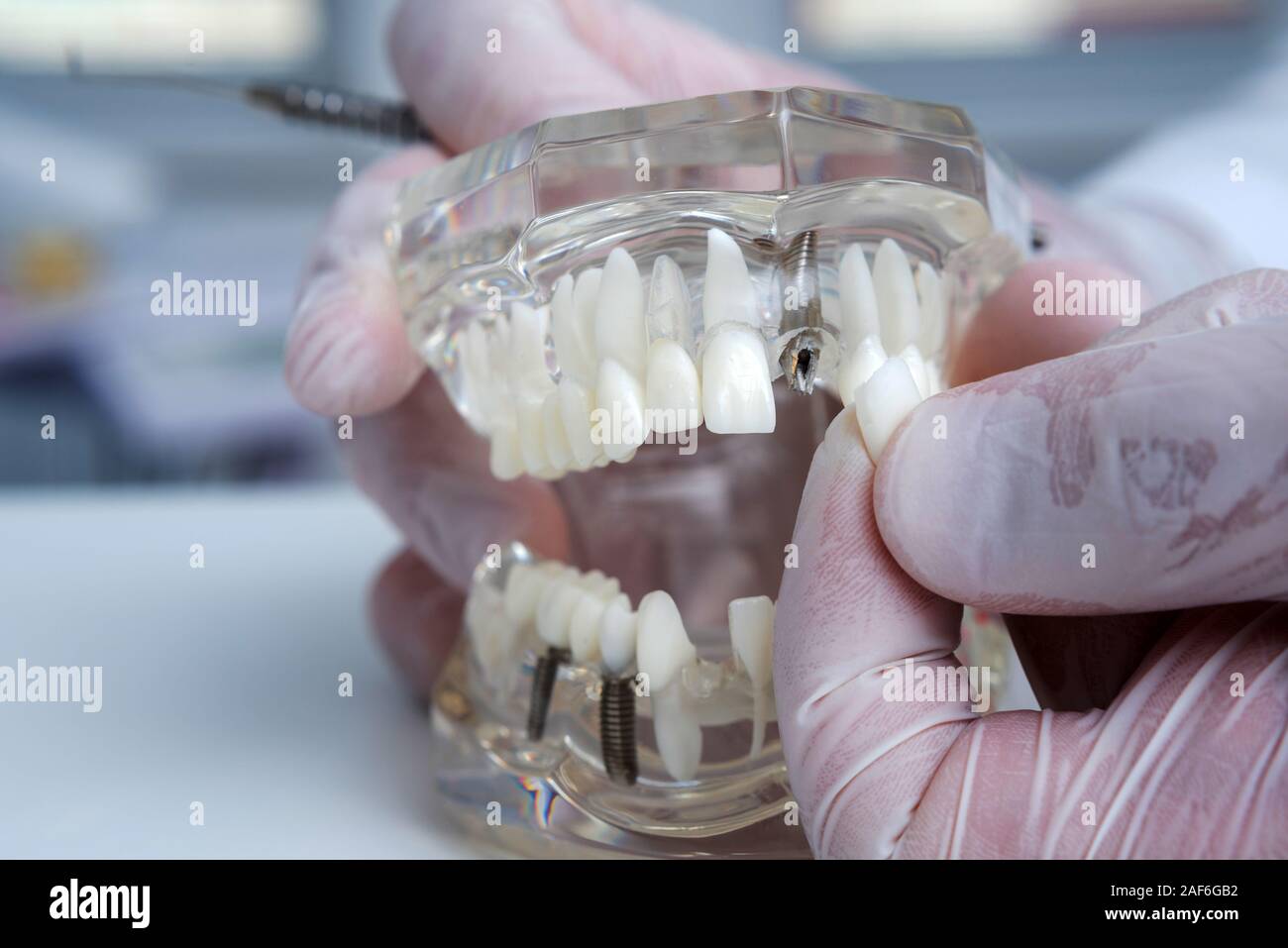 the orthodontist holds a model of teeth with implants in his hand and ...