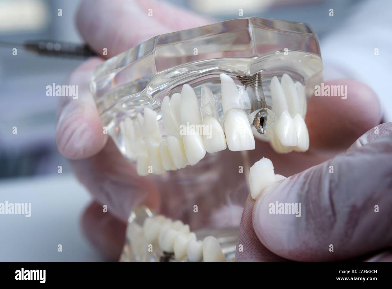 the orthodontist holds a model of teeth with implants in his hand and ...