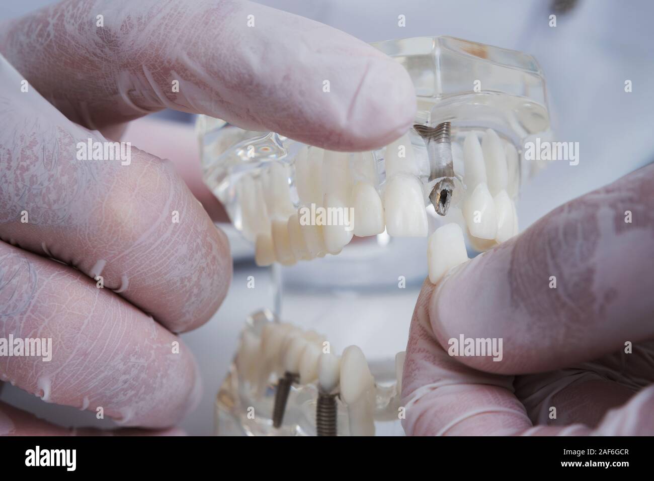 the orthodontist holds a model of teeth with implants in his hand and ...