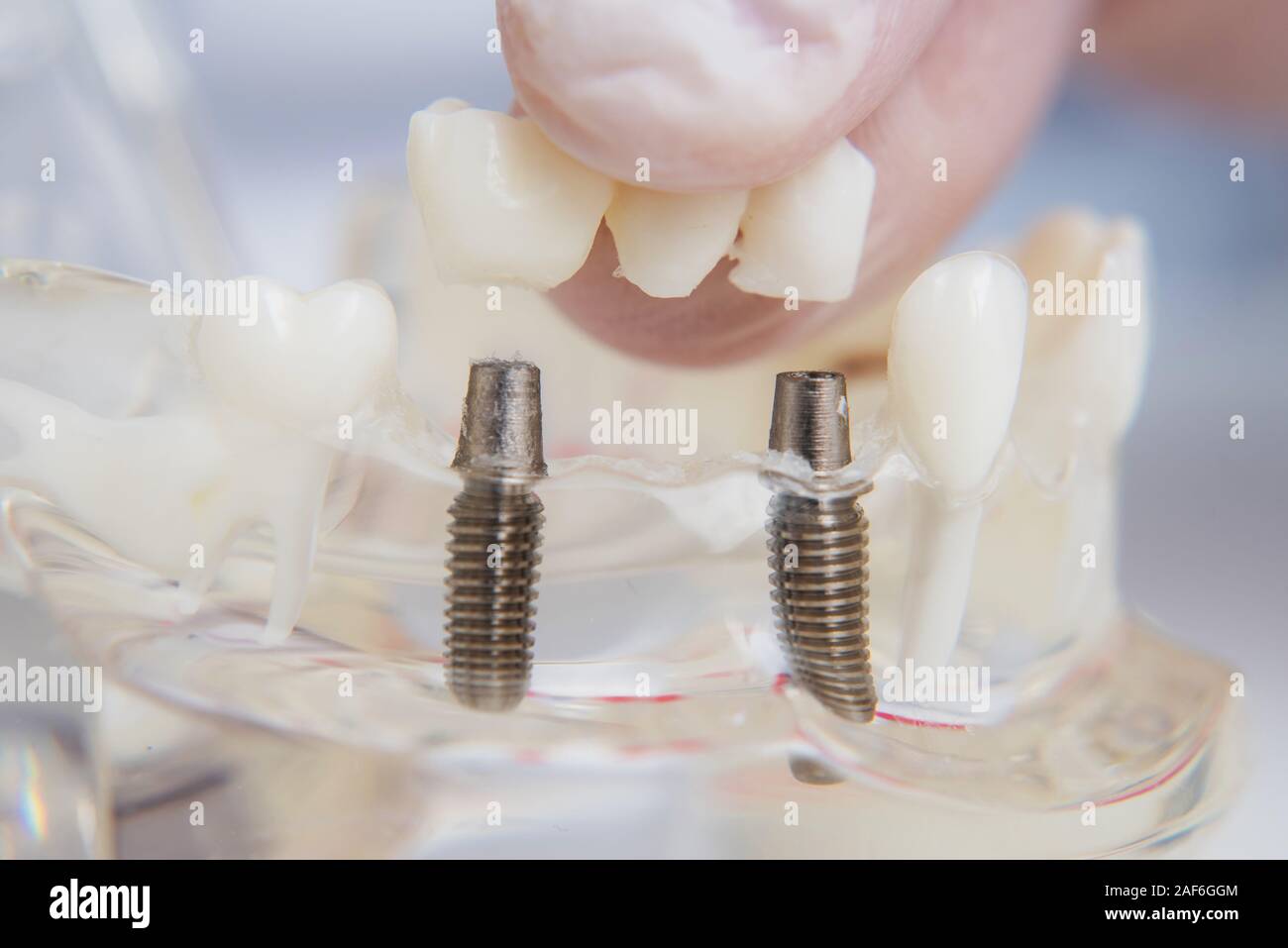 Implant Insert the doctor orthodontist shows how to insert the implant. Macro Stock ...