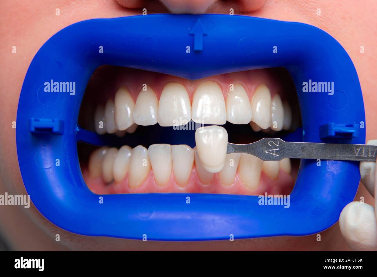 procedure for comparing the color shades of teeth before bleaching