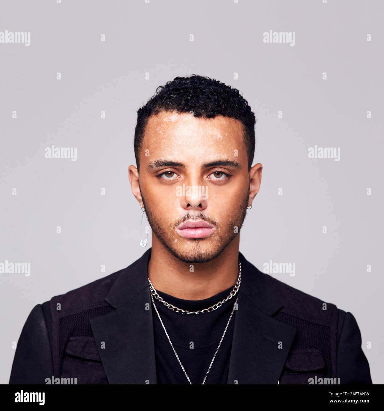 Studio Portrait Of Young Man With Skin Pigmentation Disorder Looking At Camera Stock Photo