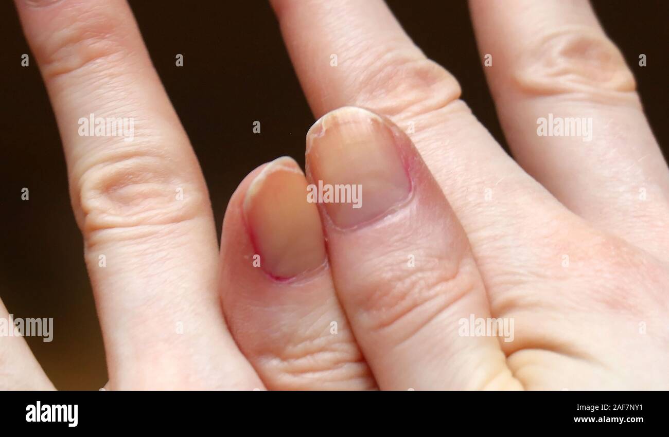 Brittle nails hires stock photography and images Alamy