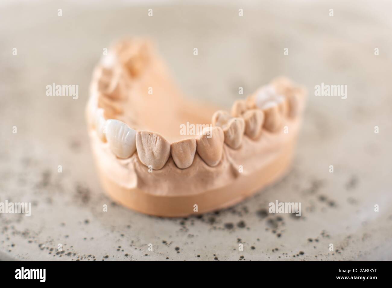 Close-up on plaster model of artificial jaw with veneers on the gypsum ...