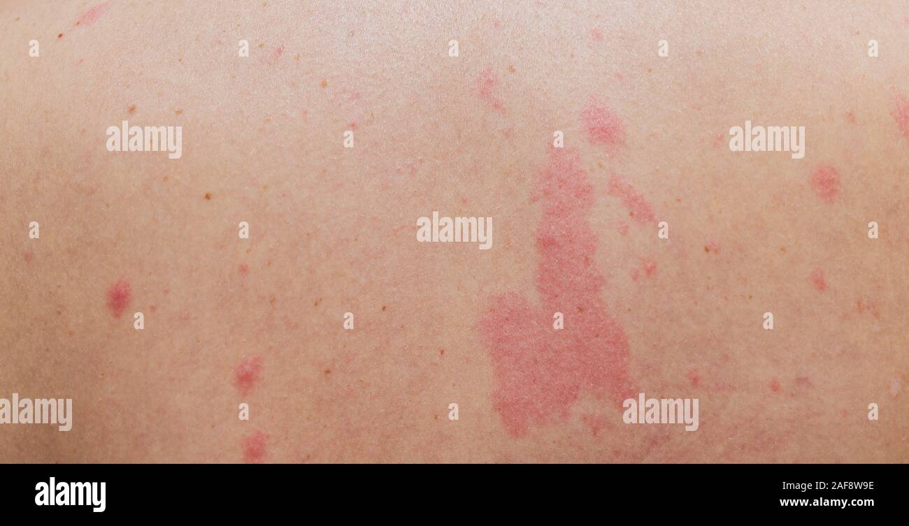 Close up Allergy rash, Around Back view of human with dermatitis