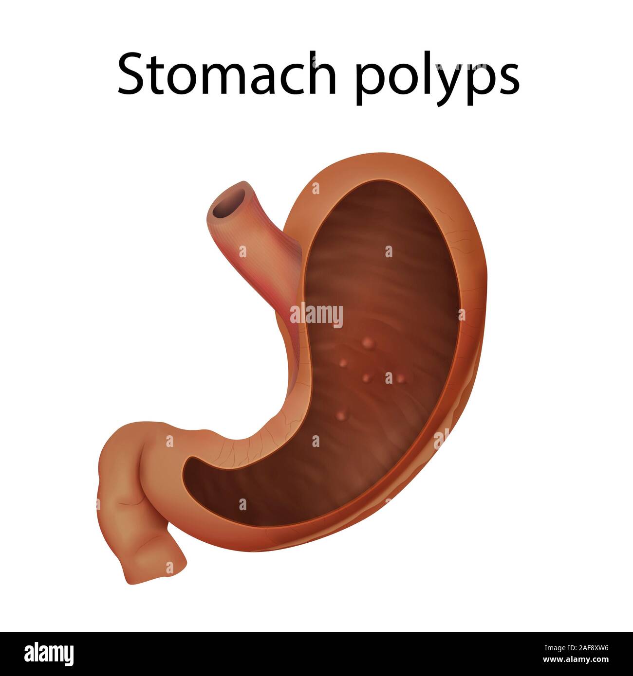 Stomach polyps, illustration Stock Photo Alamy