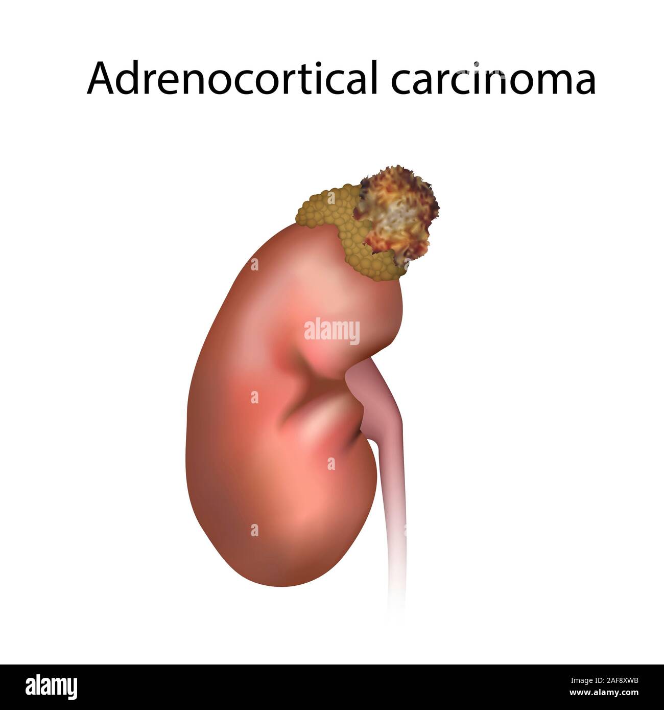 Adrenocortical carcinoma, illustration Stock Photo