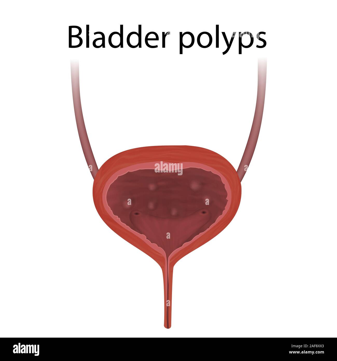 Abnormal urinary bladder hires stock photography and images Alamy