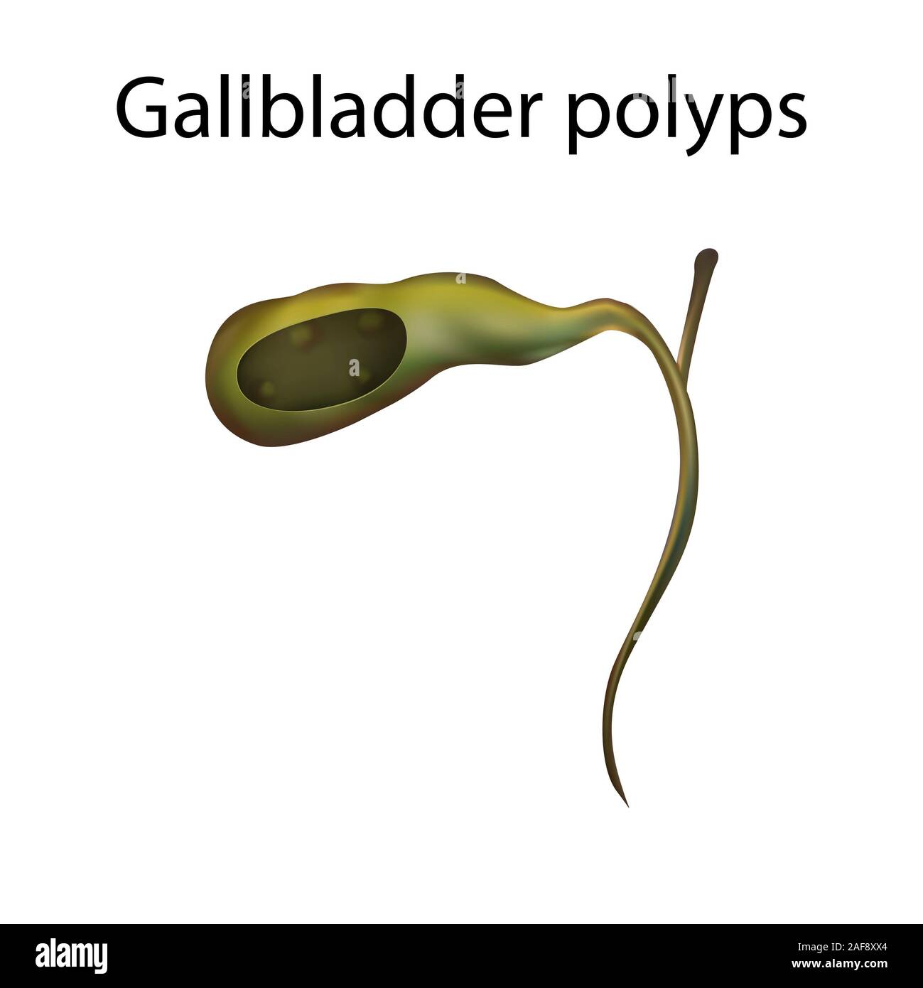 Gallbladder polyps, illustration Stock Photo