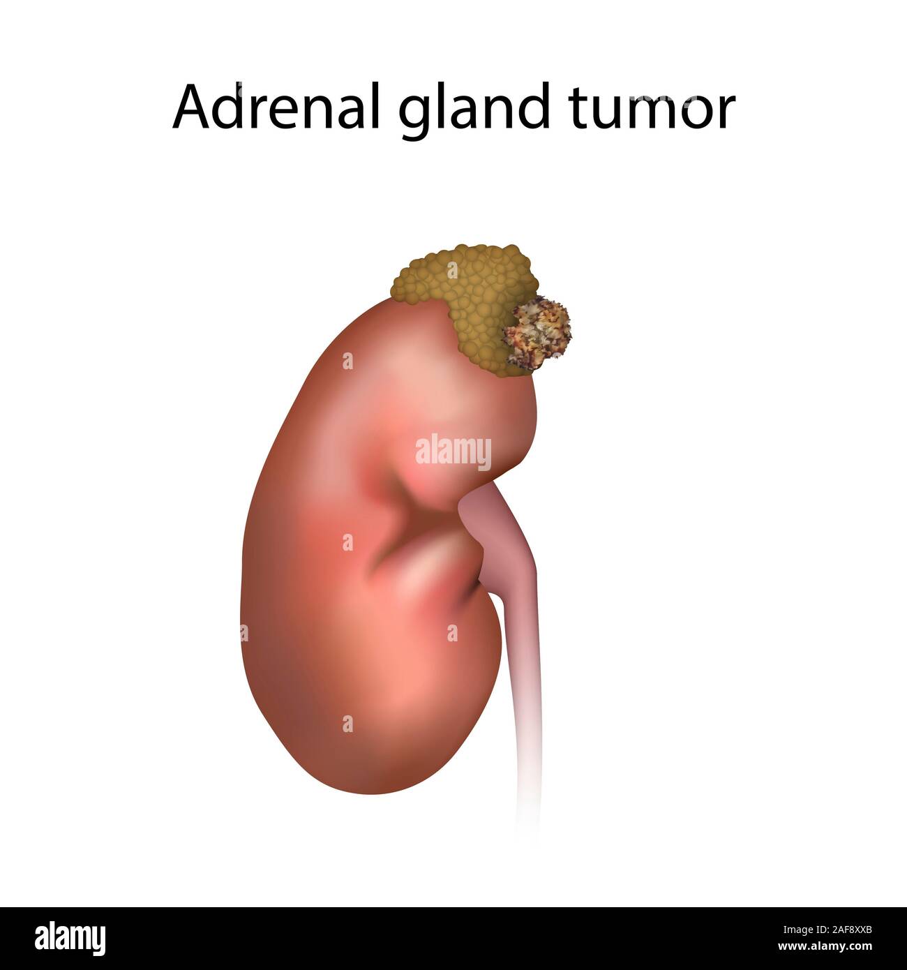 Adrenal gland tumour, illustration Stock Photo
