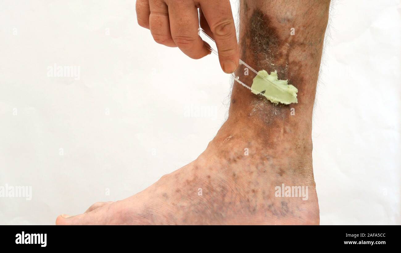 Human skin disease. Human hands apply ointment to scars, ulcers, peelings and age spots on his foot. Perhaps this is varicose veins or thrombosis on t Stock Photo