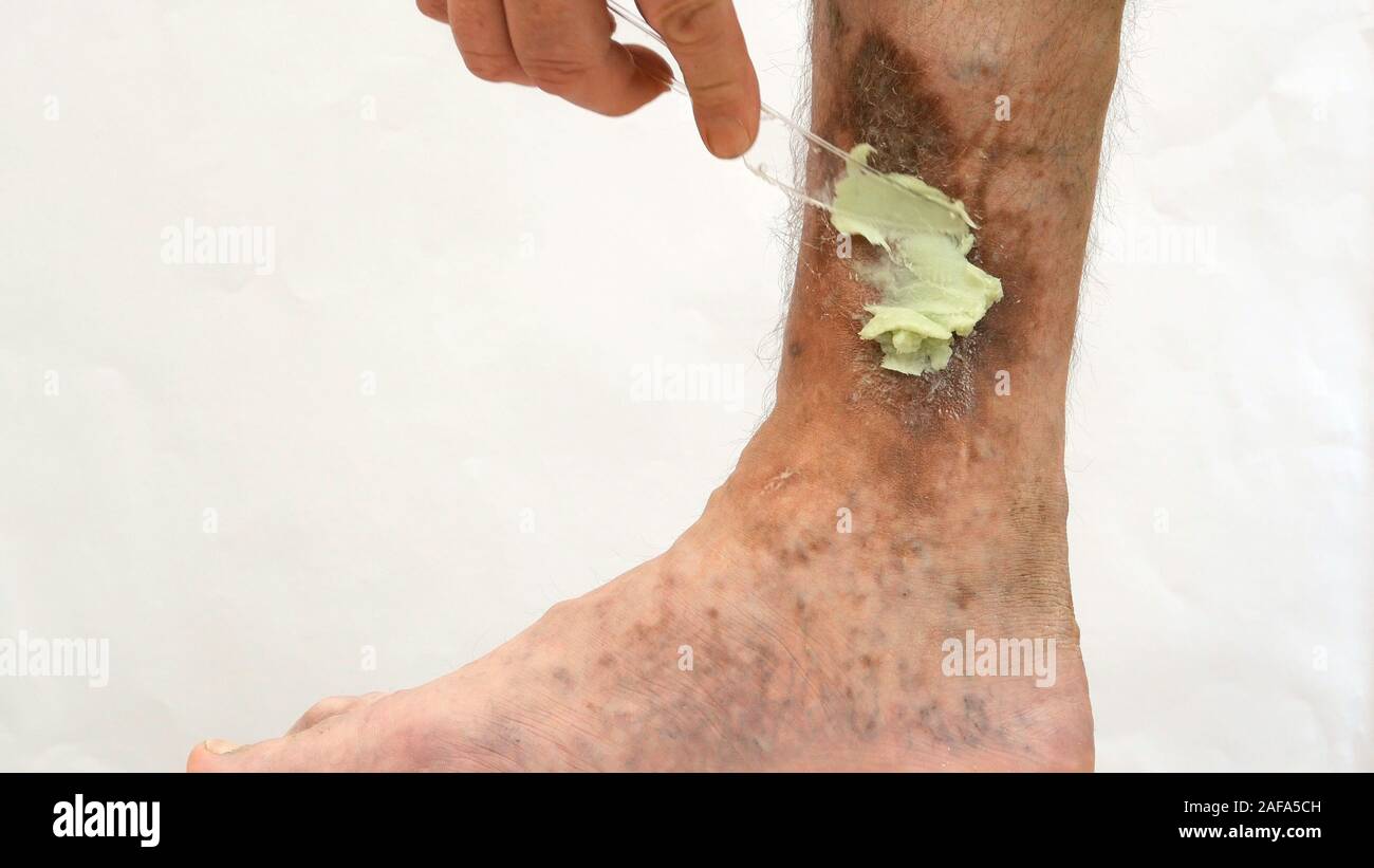 Human skin disease. Human hands apply ointment to scars, ulcers, peelings and age spots on his foot. Perhaps this is varicose veins or thrombosis on t Stock Photo