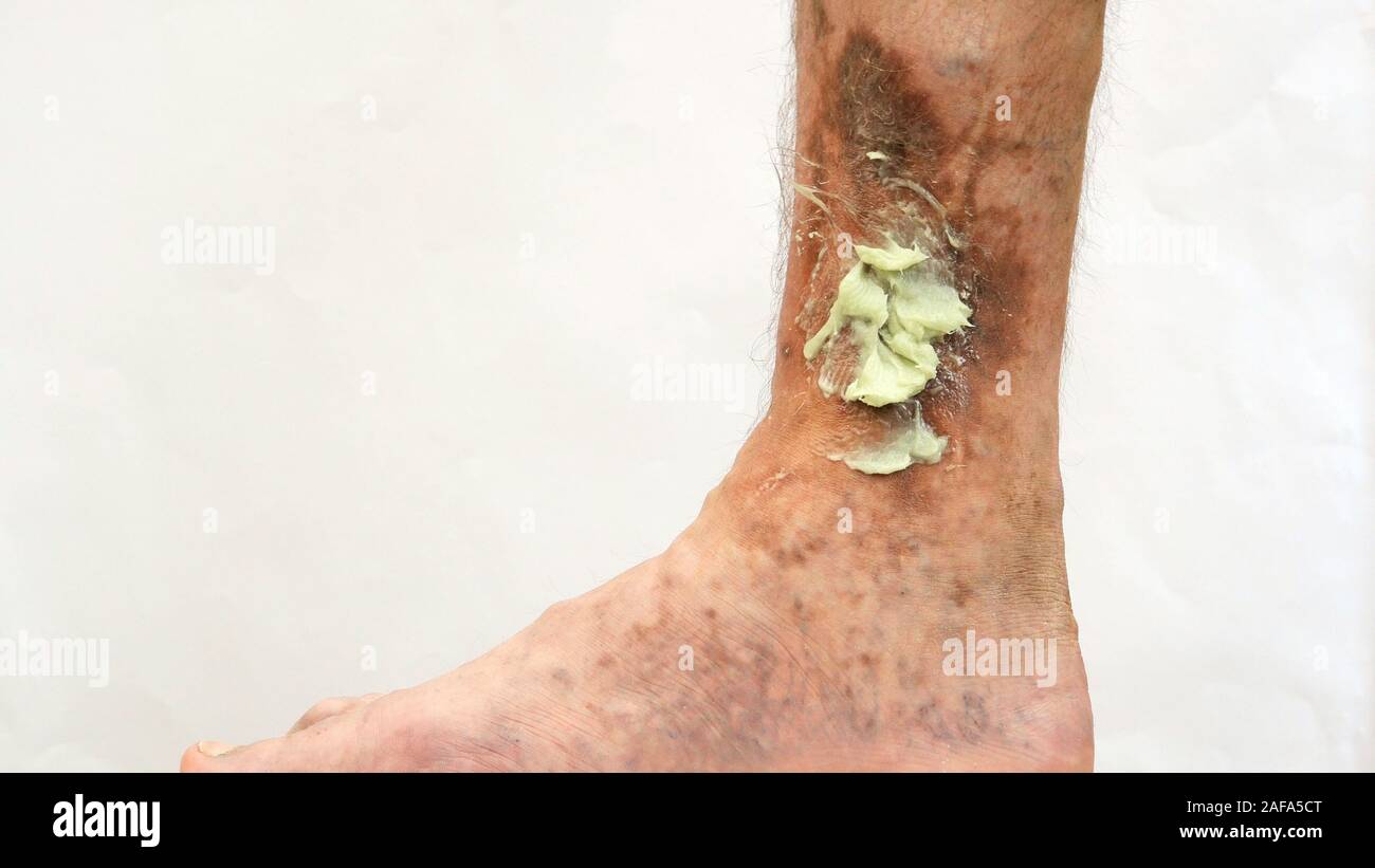 Human skin disease. Ointment on scars, ulcers, peelings and age spots on his foot. Perhaps this is varicose veins or thrombosis on the leg. Close-up. Stock Photo