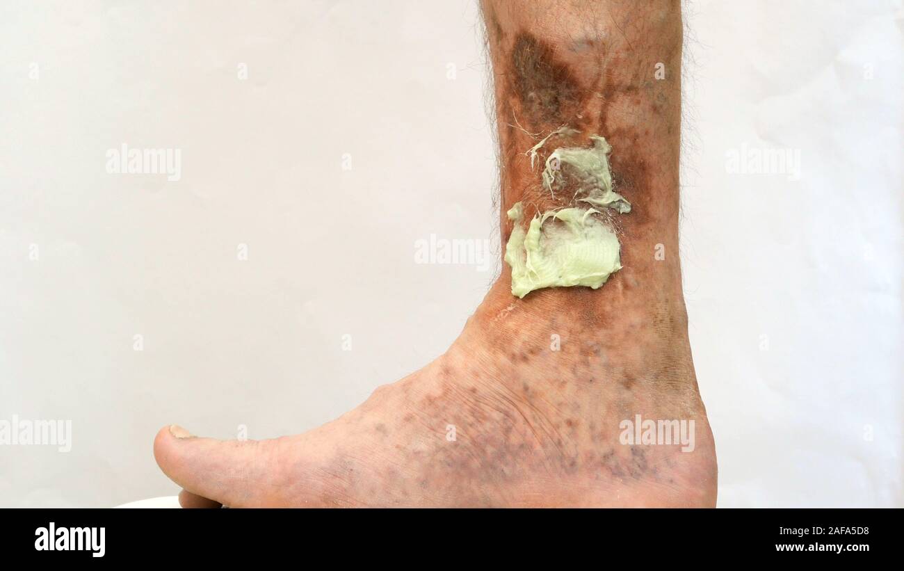 Human skin disease. Ointment on scars, ulcers, peelings and age spots on his foot. Perhaps this is varicose veins or thrombosis on the leg. Close-up. Stock Photo