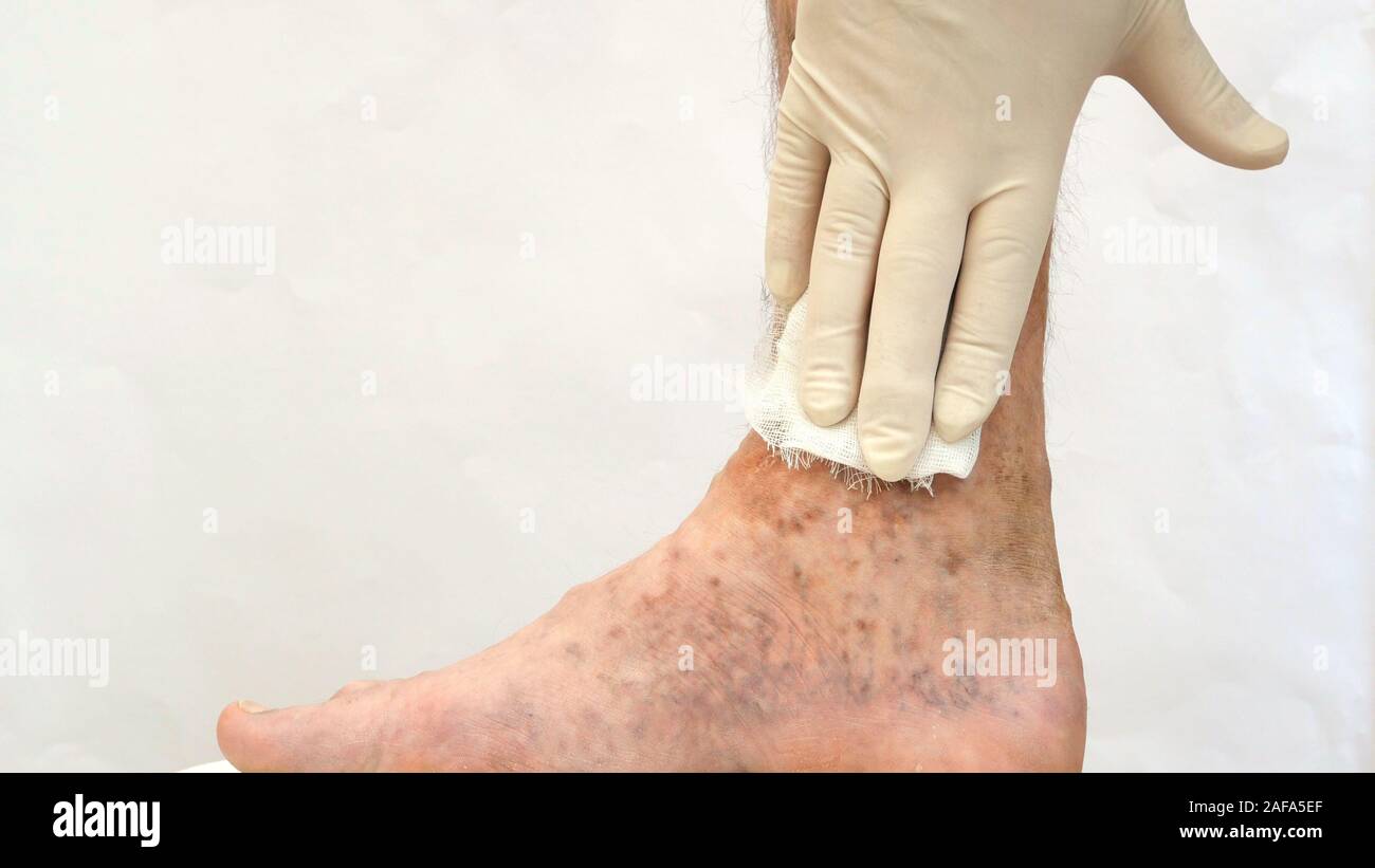 Human skin disease. Sanitary napkins on scars, ulcers, peelings and age spots on his foot. Perhaps this is varicose veins or thrombosis on the leg. Cl Stock Photo