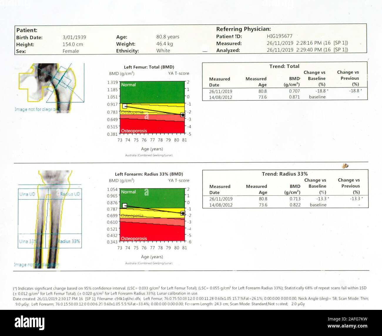 Bone density scan of left forearm and left femur of caucasian female aged 80. Stock Photo