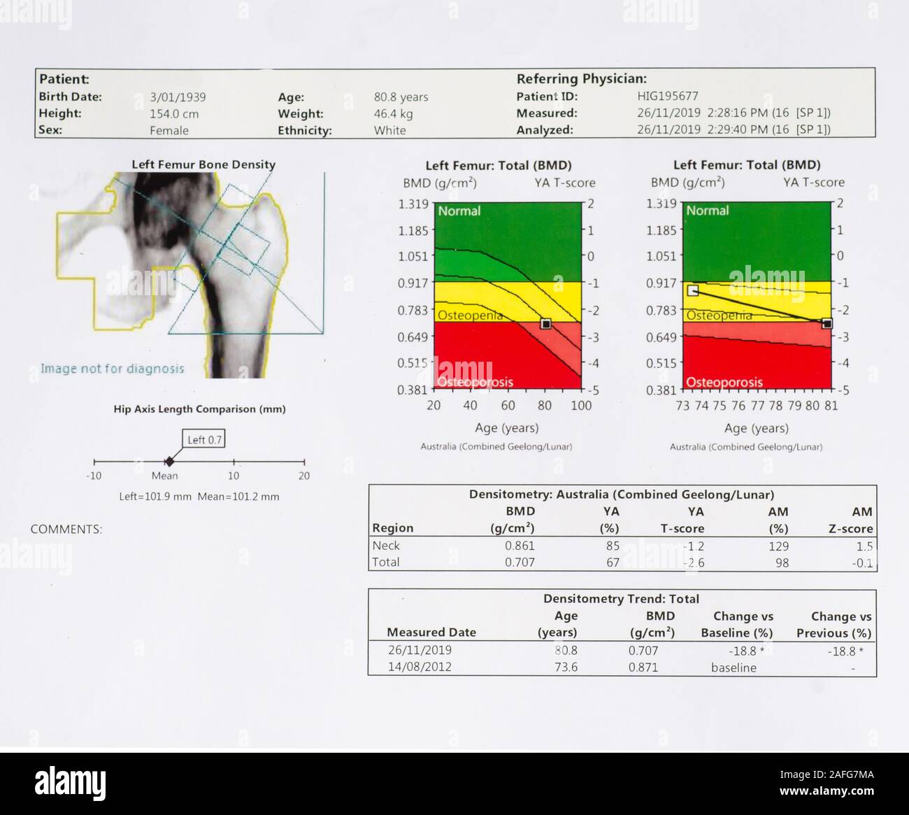 Bone density scan of left femur of Caucasian female aged 80. Stock Photo