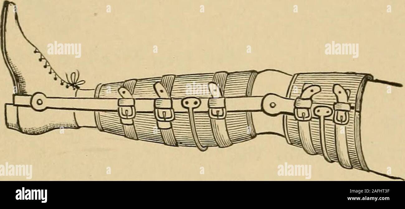 . Postoperative treatment; an epitome of the general management of postoperative care and treatment of surgical cases as practised by prominent American and European surgeons. the excitation of inflammation;but many of the old operations are at the present time abandoned as aresult of the introduction of antiseptic surgery. The use of the seton,the injection of irritating fluids, the cauterization of the fragments, theapplication of blisters and of caustic alkalis to the skin over the site ofthe ununited fracture, the introduction of electric currents, the violentpercussion with the mallet—are Stock Photo